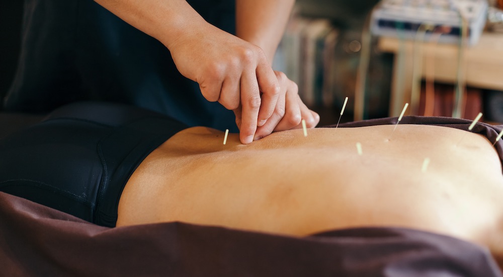 L'acupuncture